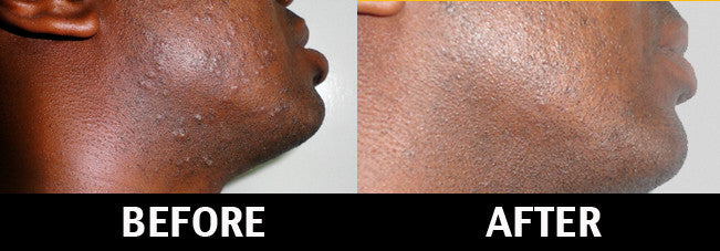 TEA-TREE & LEMONGRASS AFTERSHAVE LOTION